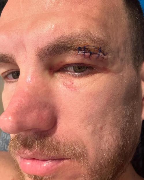 Close-up of a man's face with stitches above his eye.