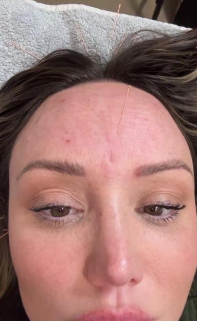 Woman receiving acupuncture treatment on her forehead.