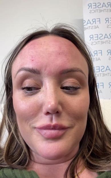 Close-up of a woman's bloodied forehead after a Botox and lip treatment.