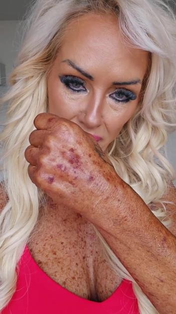 Woman's sun-damaged skin showing age spots and discoloration.