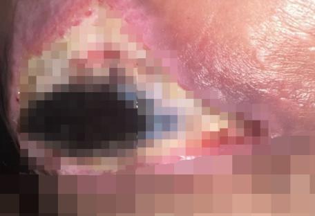 Close-up image of a large, infected wound.