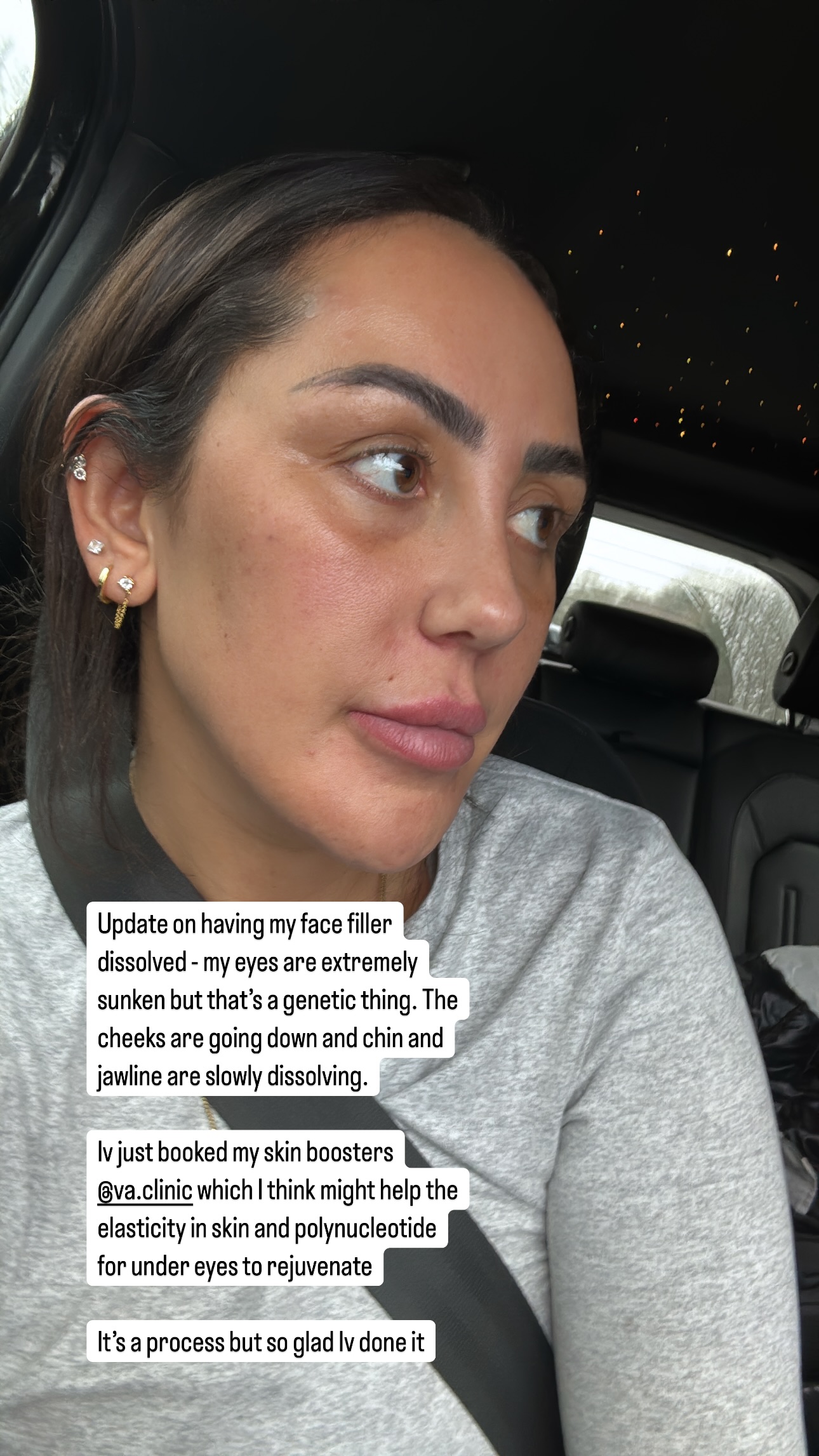 Woman in car, describing the effects of dissolving face filler.