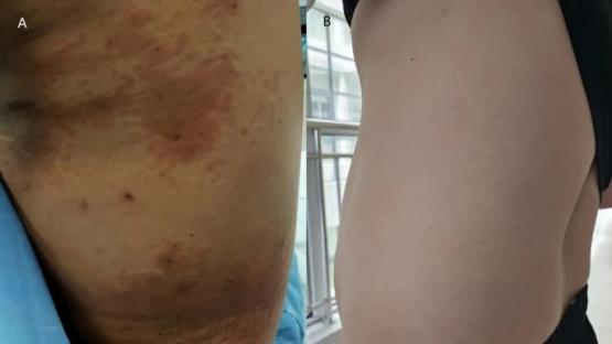 Medical images showing skin lesions before and after treatment.
